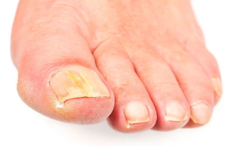 Grybelio priežastys