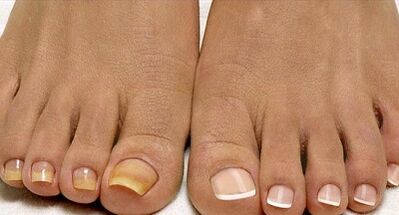 Laivyno grybelio gydymo metodai