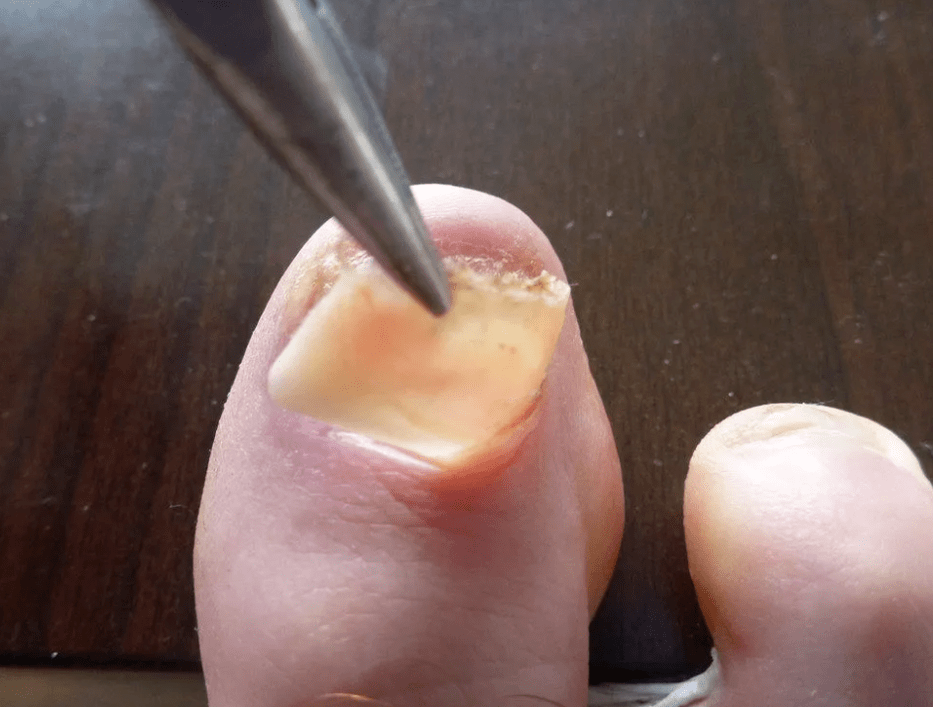 Plokštės pašalinimas