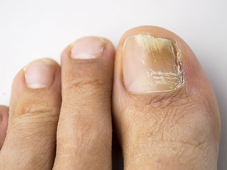 Pradinis grybelio etapas