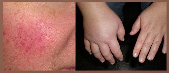 Šalutinis lašų poveikis